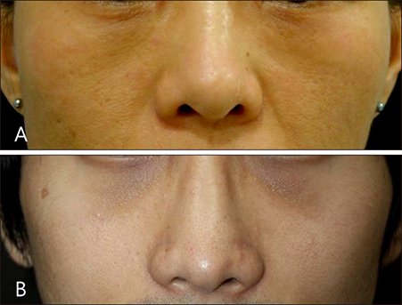 https://anndermatol.org/DOIx.php?id=10.5021/ad.2018.30.5.522  รอยคล้ำใต้ตา เกิดจากอะไรรักษาได้อย่างไรบ้าง