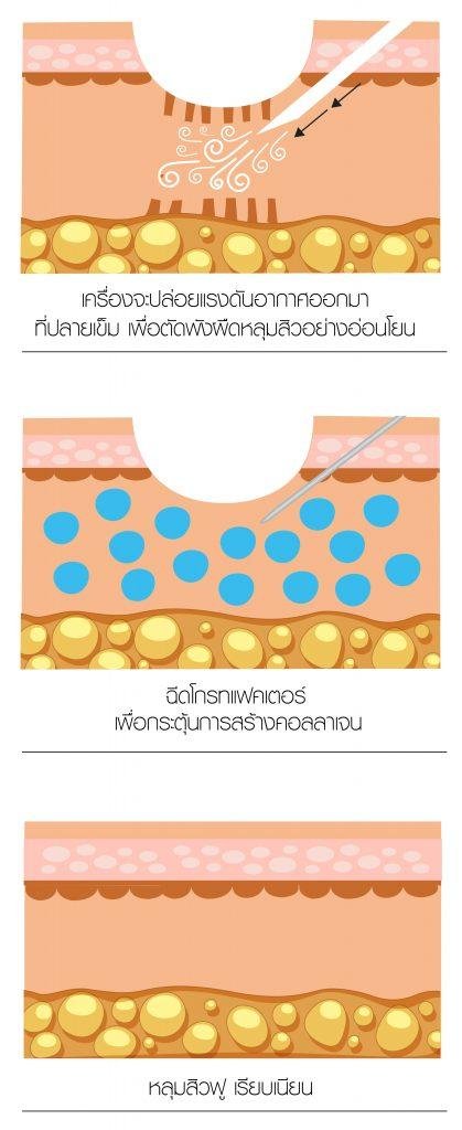 Intradermal Air – Dissector นวัตกรรมดูแลหลุมสิว ตัดพังผืดด้วยแรงดันอากาศ คืนผิวเรียบเนียน