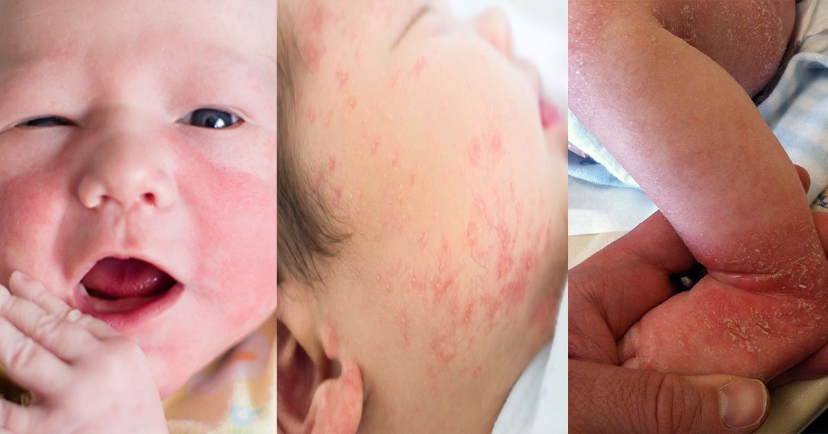 โรคผื่นภูมิแพ้ผิวหนังในเด็ก – สาเหตุและการปกป้องผิวแพ้ง่าย โดยรองศาสตราจารย์ นายแพทย์ เทอดพงศ์ เต็มภาคย์ โรคผื่นภูมิแพ้ผิวหนังในเด็ก – สาเหตุและการปกป้องผิวแพ้ง่าย โดยรองศาสตราจารย์ นายแพทย์ เทอดพงศ์ เต็มภาคย์