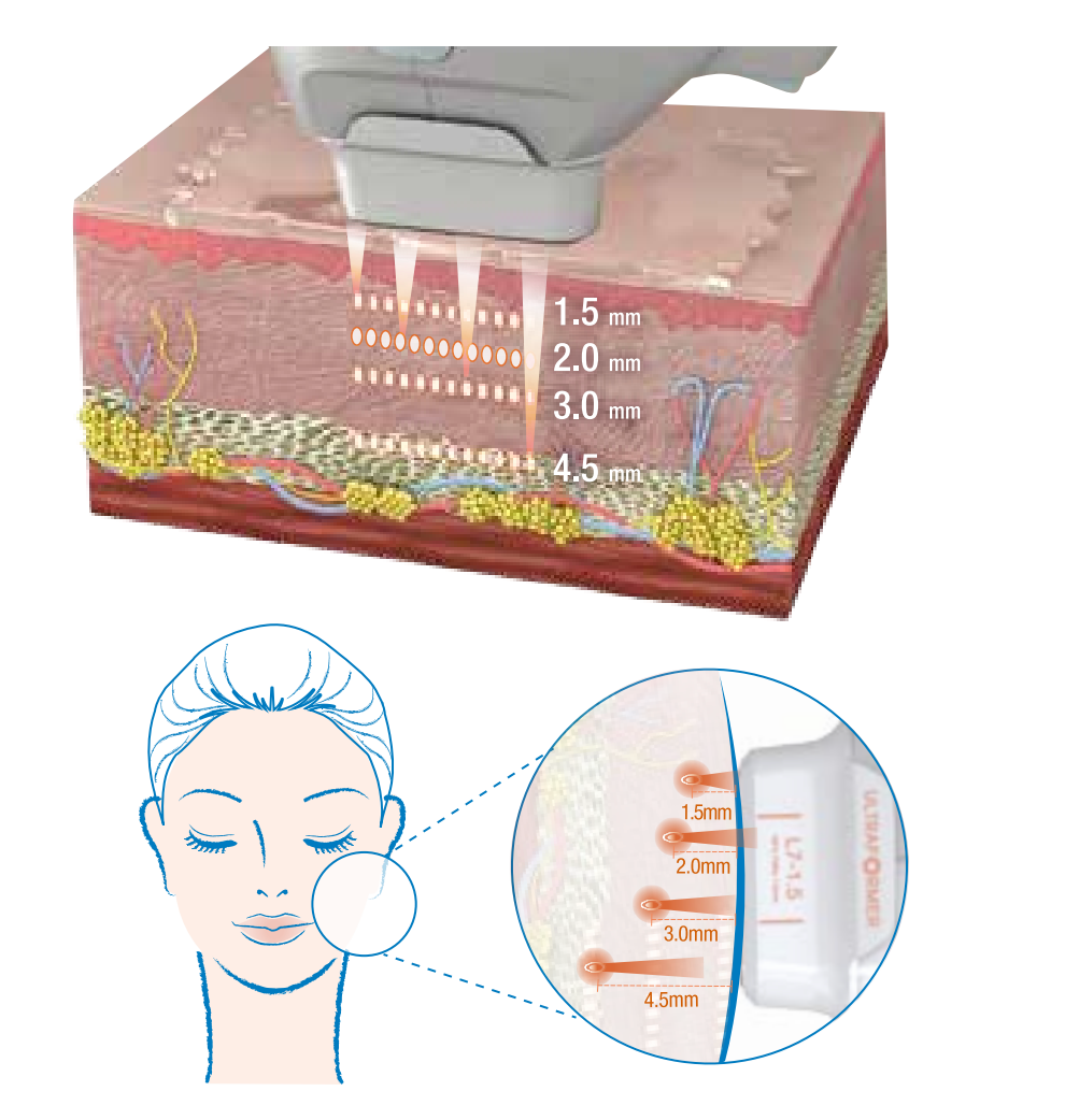 Ultraformer III Ultra HIFU นวัตกรรมใหม่ล่าสุดของการยกกระชับ คอร์ส 3 ครั้ง 19,000 บ. Ultraformer III Ultra HIFU นวัตกรรมใหม่ล่าสุดของการยกกระชับ คอร์ส 3 ครั้ง 19,000 บ.