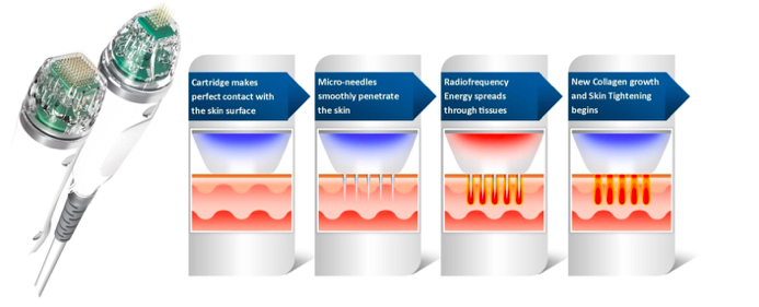 Fractional Radio Frequency RFคืออะไร มีกี่ชนิด แตกต่างกันอย่างไร ?