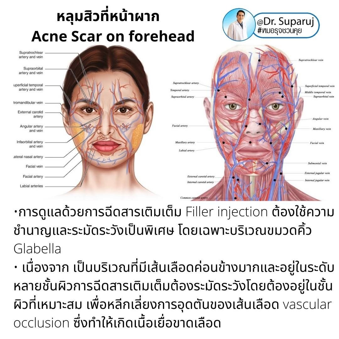 หลุมสิวที่หน้าผาก Acne Scar on forehead มีเทคนิคดูแลต่างจากบริเวณอื่นอย่างไร? หลุมสิวที่หน้าผาก Acne Scar on forehead มีเทคนิคดูแลต่างจากบริเวณอื่นอย่างไร?
