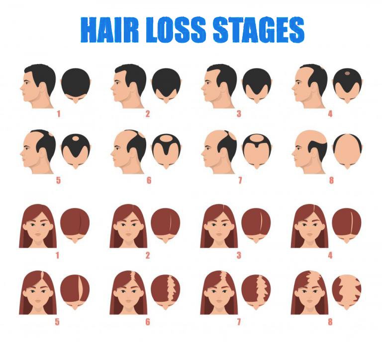 เลเซอร์ Low Level Laser Therapy LLLT ดูแลผมร่วงผมบาง เลเซอร์ Low Level Laser Therapy LLLT ดูแลผมร่วงผมบาง