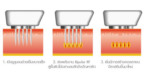 ลดเหงื่อใต้วงแขนด้วยเทคนิคคลื่นวิทยุ RF: InfiniRF Intradermal Microneedle Radiofrequency ลดเหงื่อใต้วงแขนด้วยเทคนิคคลื่นวิทยุ RF: InfiniRF Intradermal Microneedle Radiofrequency