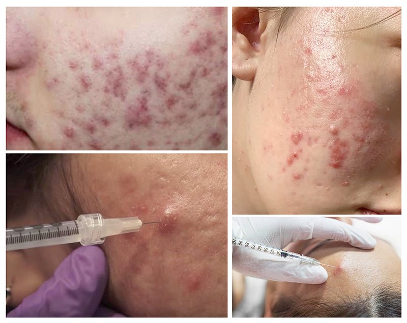 สิวอักเสบดูแลอย่างไรดี และ สิวอักเสบคืออะไร? สิวอักเสบดูแลอย่างไรดี และ สิวอักเสบคืออะไร?