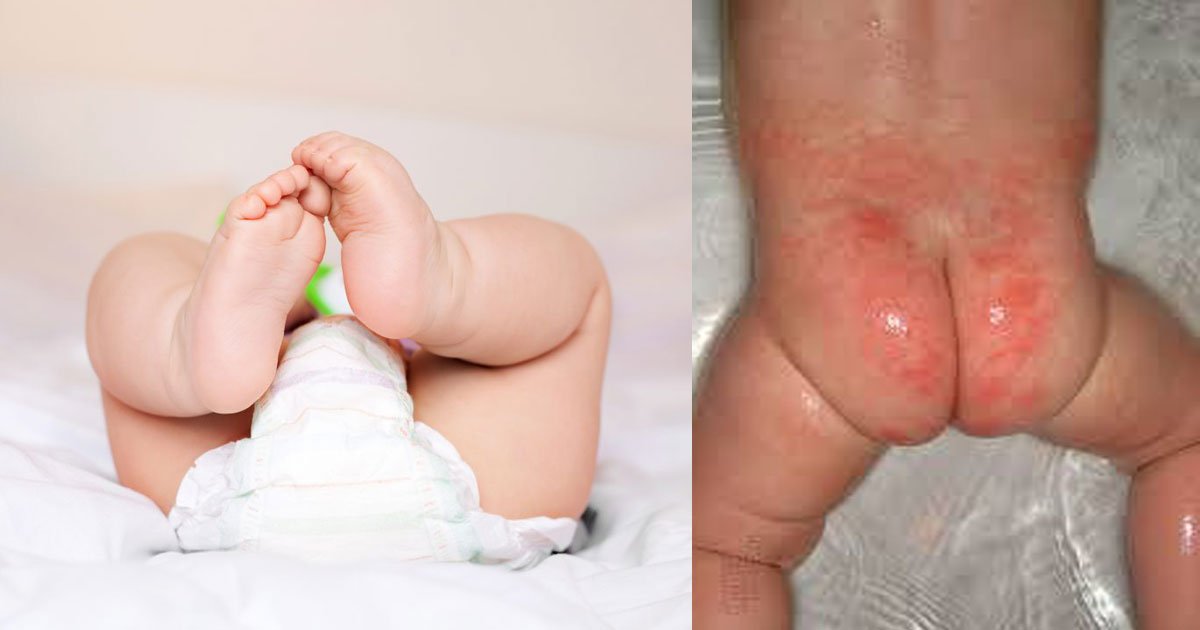 การเลือกผลิตภัณฑ์สำหรับทาป้องกันผื่นผ้าอ้อม การเลือกผลิตภัณฑ์สำหรับทาป้องกันผื่นผ้าอ้อม