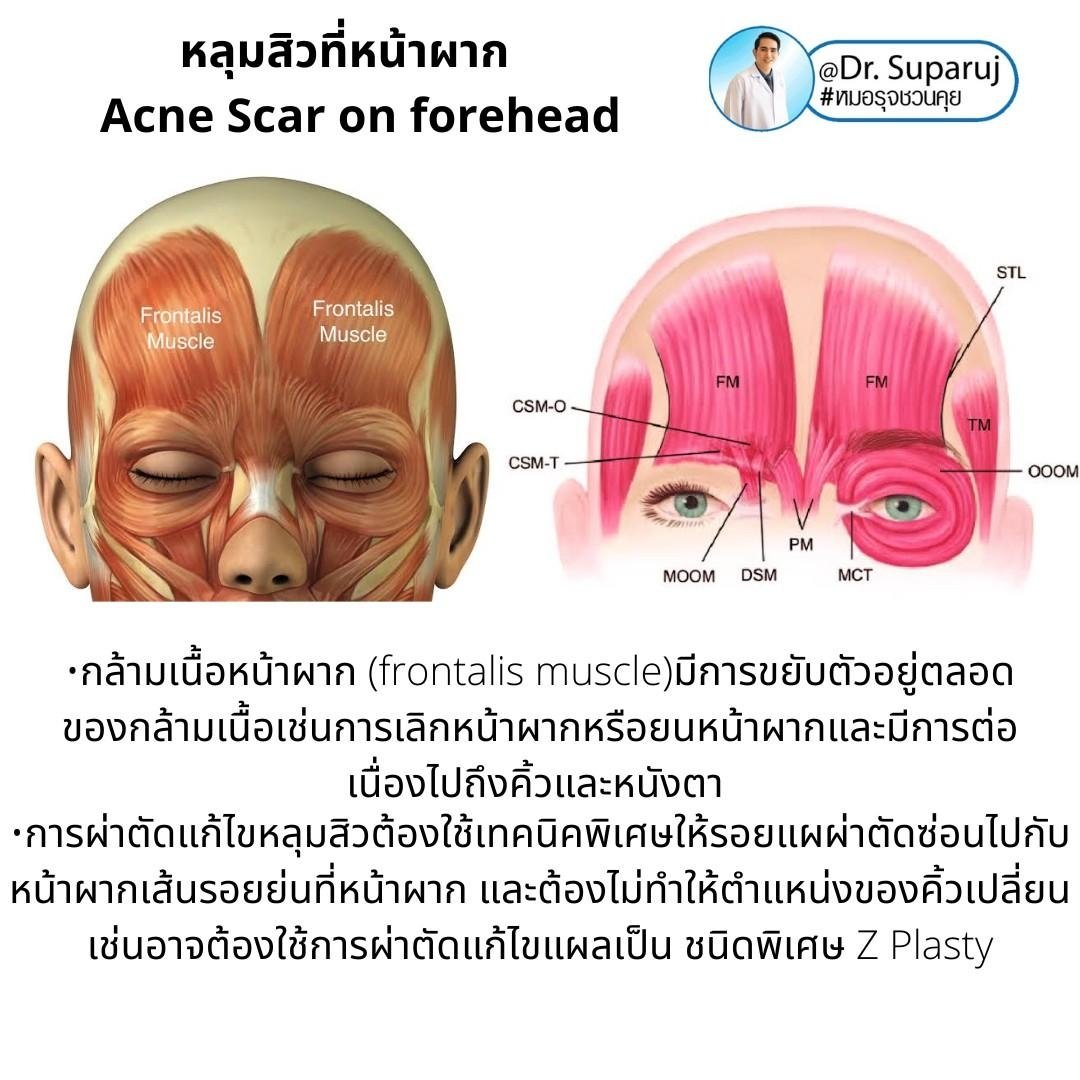หลุมสิวที่หน้าผาก Acne Scar on forehead มีเทคนิคดูแลต่างจากบริเวณอื่นอย่างไร?