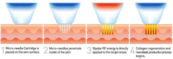 Fractional Radio Frequency RFคืออะไร มีกี่ชนิด แตกต่างกันอย่างไร ?