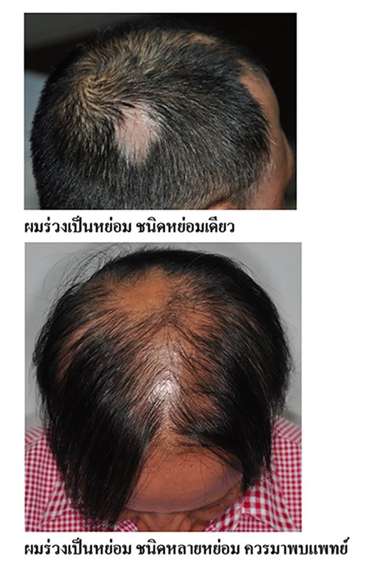 โรคผมร่วงเป็นหย่อม Alopecia Areata AA มีลักษณะอย่างไรและรักษาได้อย่างไร ? โรคผมร่วงเป็นหย่อม Alopecia Areata AA มีลักษณะอย่างไรและรักษาได้อย่างไร ?