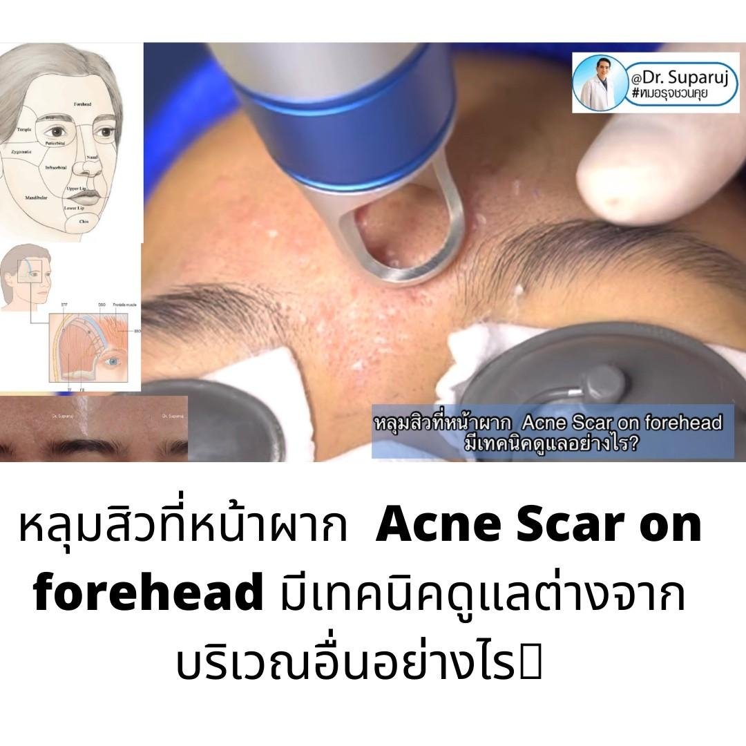 หลุมสิวที่หน้าผาก Acne Scar on forehead มีเทคนิคดูแลต่างจากบริเวณอื่นอย่างไร? หลุมสิวที่หน้าผาก Acne Scar on forehead มีเทคนิคดูแลต่างจากบริเวณอื่นอย่างไร?