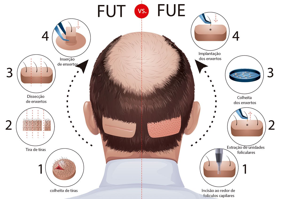 การปลูกผม (Hair Transplantation) คืออะไร การปลูกผม (Hair Transplantation) คืออะไร