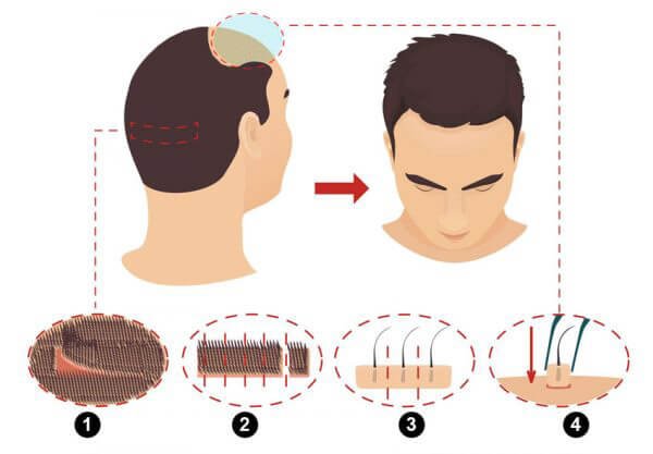 การปลูกผม (Hair Transplantation) คืออะไร การปลูกผม (Hair Transplantation) คืออะไร