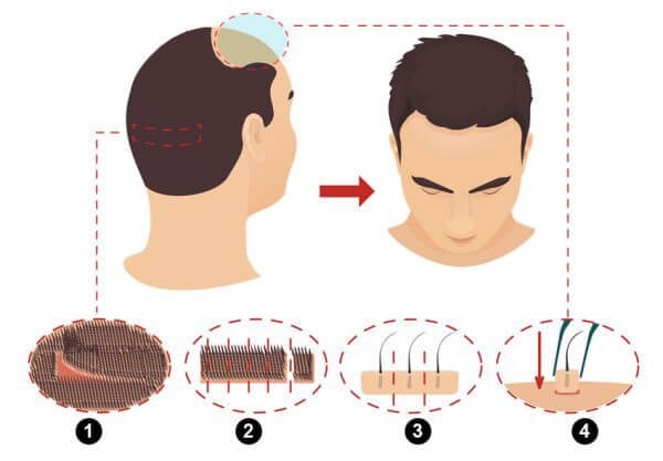 การปลูกผม (Hair Transplantation) คืออะไร