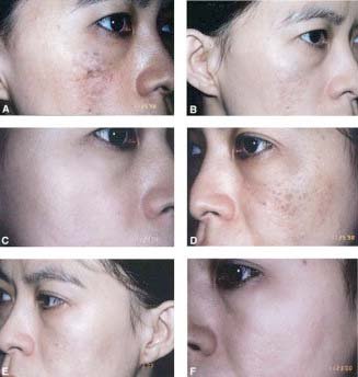 ดูแลปานดำโอตะ Nevus of Ota ด้วย Picosecond Laser