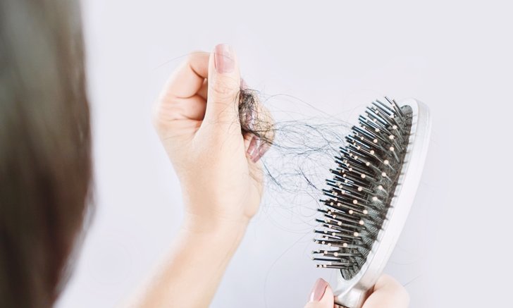 โรคผมร่วงเป็นหย่อม Alopecia Areata AA มีลักษณะอย่างไรและรักษาได้อย่างไร ? โรคผมร่วงเป็นหย่อม Alopecia Areata AA มีลักษณะอย่างไรและรักษาได้อย่างไร ?