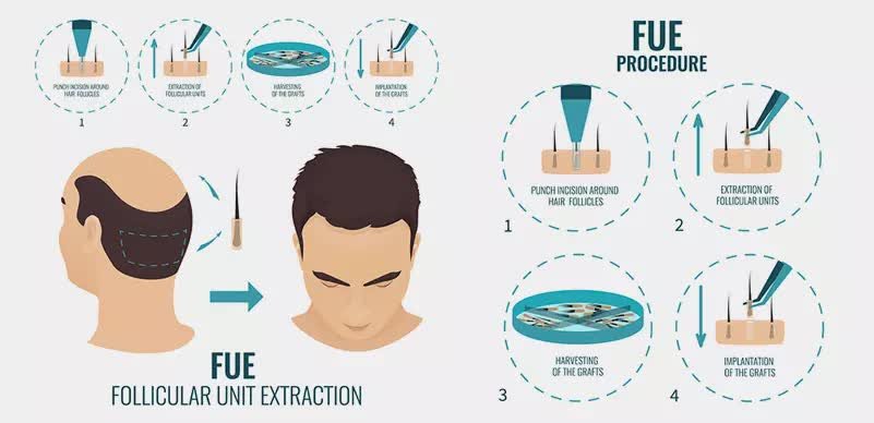 การปลูกผม (Hair Transplantation) คืออะไร การปลูกผม (Hair Transplantation) คืออะไร