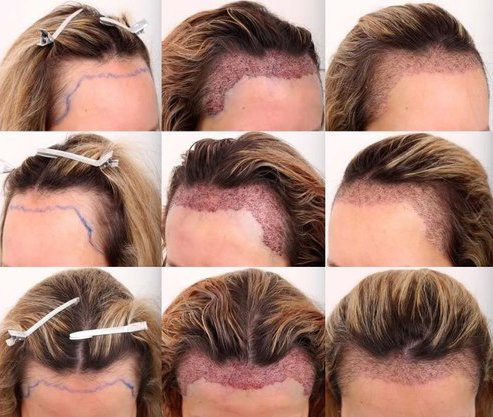การปลูกผม (Hair Transplantation) คืออะไร การปลูกผม (Hair Transplantation) คืออะไร