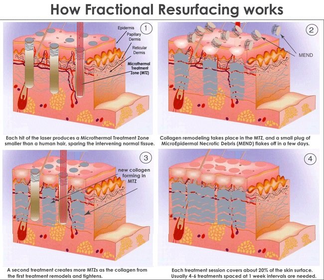 รักษาหลุมสิวด้วยเลเซอร์กรอผิวชนิดลอกทั้งช้ันผิว Full field vs ลอกแบบแบ่งส่วน Fractional Ablative Laser Resurfacing มีจุดเด่นและการใช้แตกต่างกันอย่างไร ? รักษาหลุมสิวด้วยเลเซอร์กรอผิวชนิดลอกทั้งช้ันผิว Full field vs ลอกแบบแบ่งส่วน Fractional Ablative Laser Resurfacing มีจุดเด่นและการใช้แตกต่างกันอย่างไร ?