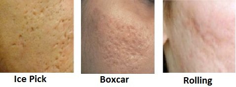 การดูแลหลุมสิวลึกด้วยการแต้ม TCA CROSS (TCA Chemical Reconstruction of Skin Scars)