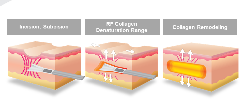 การรักษารอยแผลเป็นแบบหลุมจากสิว Atrophic Acne Scar ด้วยการผ่าตัด Scar Revision คืออะไร ?