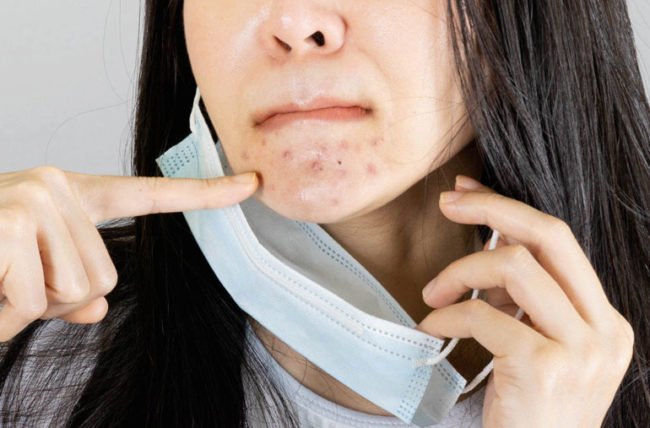 เป็นสิวจากการใส่หน้ากากอนามัยทำอย่างไรดี เป็นสิวจากการใส่หน้ากากอนามัยทำอย่างไรดี
