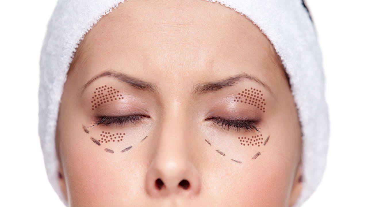 หนังตาตก คิ้วตก แก้ได้ไม่ต้องผ่าตัด ด้วยเลเซอร์แก้ไขหนังตาตก หนังตาตก คิ้วตก แก้ได้ไม่ต้องผ่าตัด ด้วยเลเซอร์แก้ไขหนังตาตก