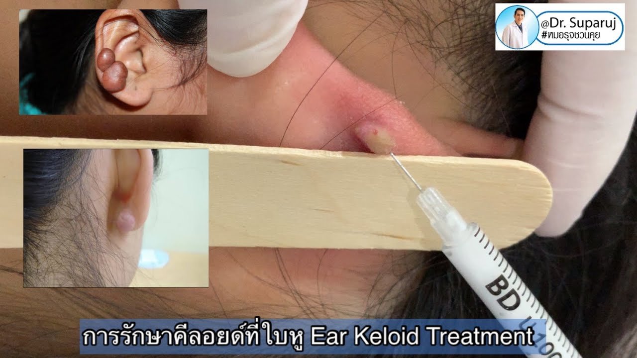 แนะนำเทคนิคดูแลแผลเป็นนูนคีลอยด์ Ep. 3 คีลอยด์ใบหู? Ear Keloid ดูแลได้อย่างไร? แนะนำเทคนิคดูแลแผลเป็นนูนคีลอยด์ Ep. 3 คีลอยด์ใบหู? Ear Keloid ดูแลได้อย่างไร?