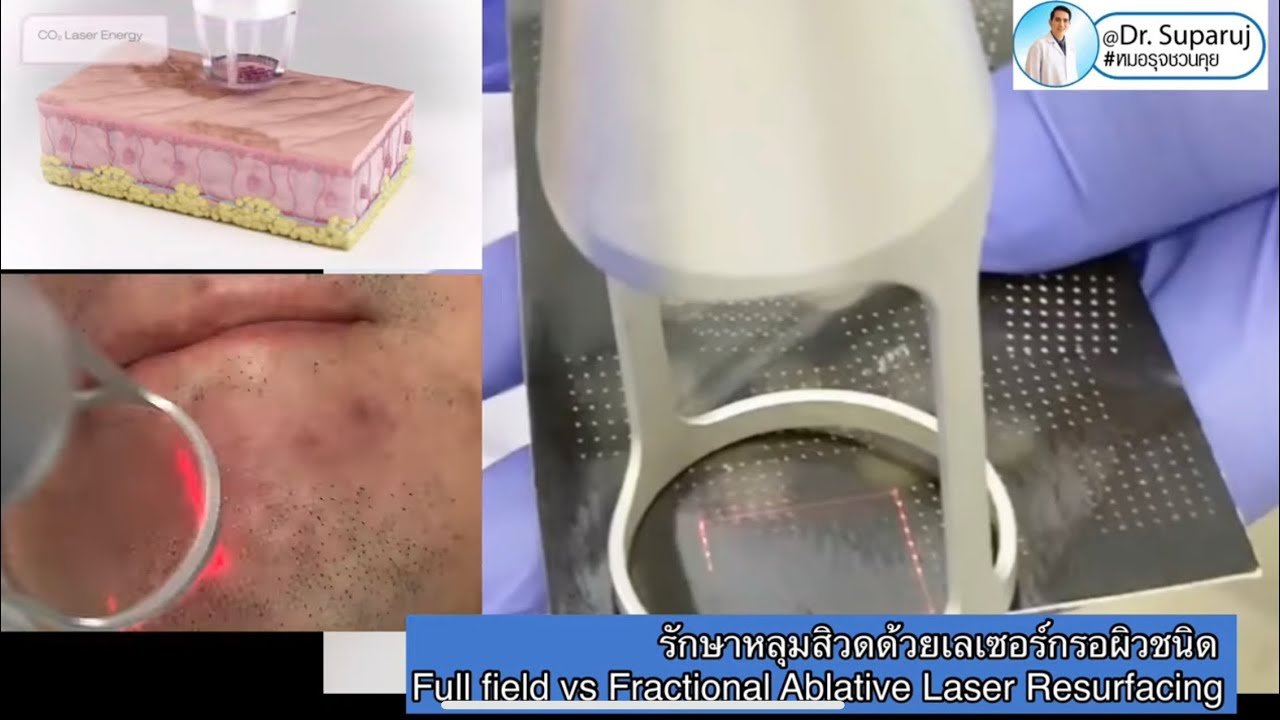 รักษาหลุมสิวด้วยเลเซอร์กรอผิวชนิดลอกทั้งช้ันผิว Full field vs ลอกแบบแบ่งส่วน Fractional Ablative Laser Resurfacing มีจุดเด่นและการใช้แตกต่างกันอย่างไร ? รักษาหลุมสิวด้วยเลเซอร์กรอผิวชนิดลอกทั้งช้ันผิว Full field vs ลอกแบบแบ่งส่วน Fractional Ablative Laser Resurfacing มีจุดเด่นและการใช้แตกต่างกันอย่างไร ?