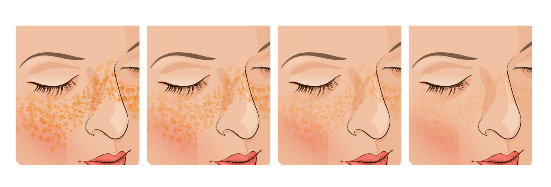 ฝ้ามีกี่ชนิด Melasma Type? ฝ้ามีกี่ชนิด Melasma Type?