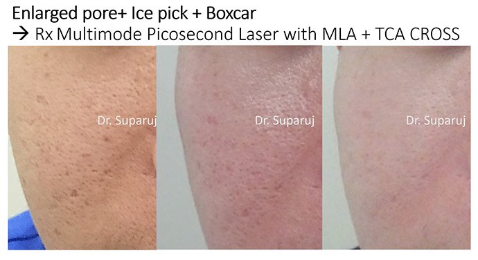 รูขุมขนกว้าง Enlarged Facial Pore ดูแลได้อย่างไร Part II? รูขุมขนกว้าง Enlarged Facial Pore ดูแลได้อย่างไร Part II?