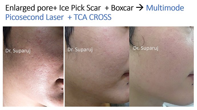 รูขุมขนกว้าง Enlarged Facial Pore ดูแลได้อย่างไร Part II?