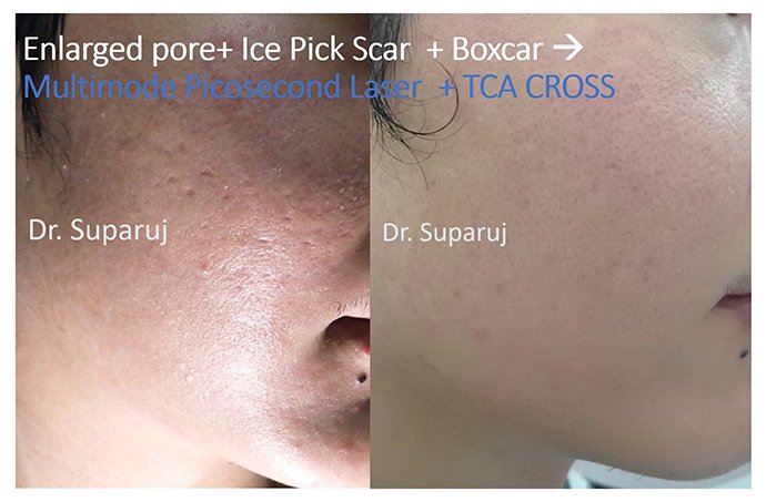 รูขุมขนกว้าง Enlarged facial Pore เกิดจากอะไรดูแลได้อย่างไร Part I ? รูขุมขนกว้าง Enlarged facial Pore เกิดจากอะไรดูแลได้อย่างไร Part I ?รูขุมขนกว้าง Enlarged facial Pore เกิดจากอะไรดูแลได้อย่างไร Part I ?