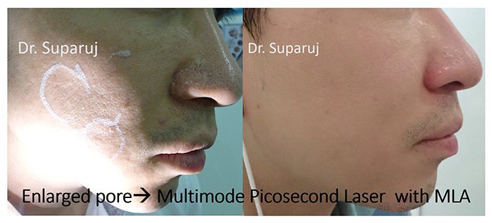 รูขุมขนกว้าง Enlarged facial Pore เกิดจากอะไรดูแลได้อย่างไร Part I ?