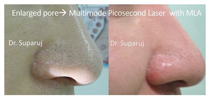 รูขุมขนกว้าง Enlarged facial Pore เกิดจากอะไรดูแลได้อย่างไร Part I ? รูขุมขนกว้าง Enlarged facial Pore เกิดจากอะไรดูแลได้อย่างไร Part I ?