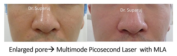 รูขุมขนกว้าง Enlarged facial Pore เกิดจากอะไรดูแลได้อย่างไร Part I ? รูขุมขนกว้าง Enlarged facial Pore เกิดจากอะไรดูแลได้อย่างไร Part I ?