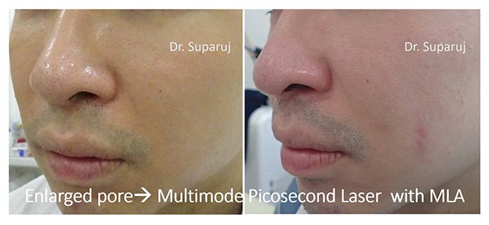 รูขุมขนกว้าง Enlarged facial Pore เกิดจากอะไรดูแลได้อย่างไร Part I ? รูขุมขนกว้าง Enlarged facial Pore เกิดจากอะไรดูแลได้อย่างไร Part I ?