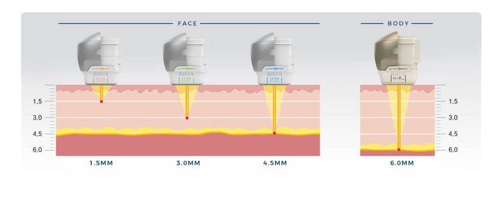 Ultraformer III HIFU MMFU นวัตกรรมใหม่ล่าสุดของการยกกระชับ Ultraformer III HIFU MMFU นวัตกรรมใหม่ล่าสุดของการยกกระชับ