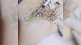 การฉีด โบทูลินั่มท็อกซิน Botulinum Toxin (Botox) เพื่อรักษาภาวะเหงื่อออกมาก (Hyperhidrosis) เฉพาะที่  การฉีด โบทูลินั่มท็อกซิน Botulinum Toxin (Botox) เพื่อรักษาภาวะเหงื่อออกมาก (Hyperhidrosis) เฉพาะที่
