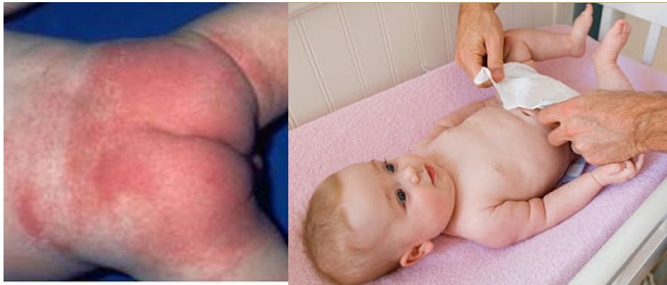 การเลือกผลิตภัณฑ์สำหรับทาป้องกันผื่นผ้าอ้อม การเลือกผลิตภัณฑ์สำหรับทาป้องกันผื่นผ้าอ้อม