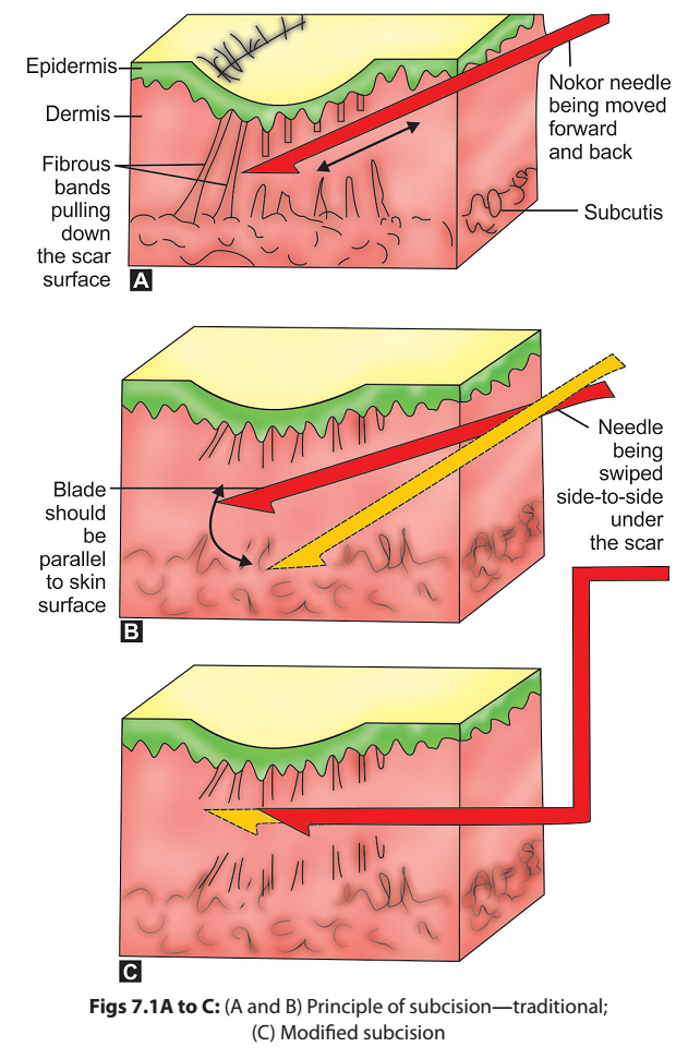 การรักษารอยแผลเป็นแบบหลุมจากสิว Atrophic Acne Scar ด้วยการผ่าตัด Scar Revision คืออะไร ?