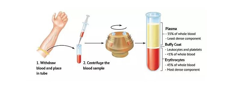 นวัตกรรมการฉีดเกล็ดเลือดเพื่อปลูกผมหรือ PRP or Platelet Rich Plasma (พลาสมาที่มีเกล็ดเลือดเข้มข้น) 