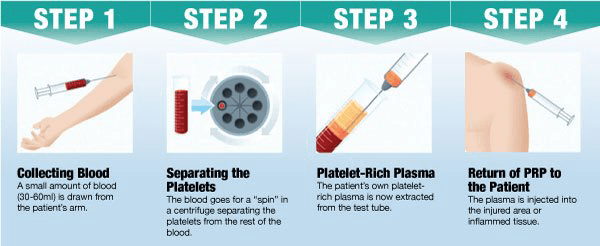 นวัตกรรมการฉีดเกล็ดเลือดเพื่อปลูกผมหรือ PRP or Platelet Rich Plasma (พลาสมาที่มีเกล็ดเลือดเข้มข้น) 