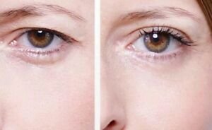 หนังตาตก คิ้วตก แก้ได้ไม่ต้องผ่าตัด ด้วยเลเซอร์แก้ไขหนังตาตก หนังตาตก คิ้วตก แก้ได้ไม่ต้องผ่าตัด ด้วยเลเซอร์แก้ไขหนังตาตก