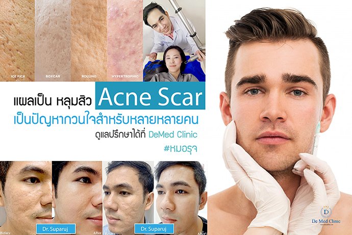 แผลเป็น หลุมสิว Acne Scar   เป็นปัญหากวนใจสำหรับหลายหลายคน ดูแลปรึกษาได้ที่ DeMed Clinic #หมอรุจ
