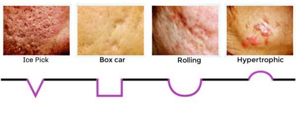 การดูแลหลุมสิวลึกด้วยการแต้ม TCA CROSS (TCA Chemical Reconstruction of Skin Scars)