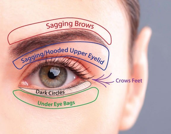 หนังตาตก คิ้วตก แก้ได้ไม่ต้องผ่าตัด ด้วยเลเซอร์แก้ไขหนังตาตก หนังตาตก คิ้วตก แก้ได้ไม่ต้องผ่าตัด ด้วยเลเซอร์แก้ไขหนังตาตก