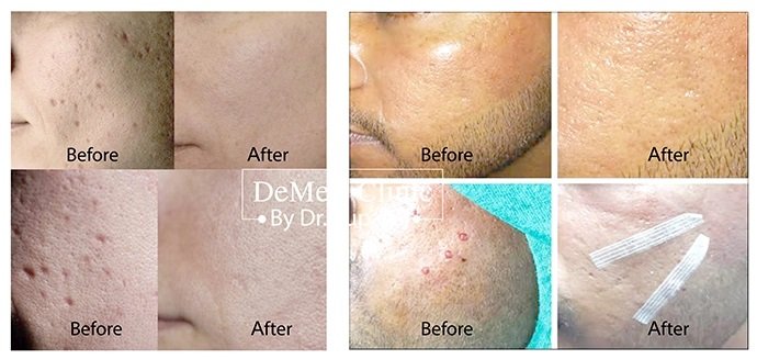 ดูแลหลุมสิวด้วยเทคนิคศัลยกรรมหลุมสิว Acne Scar Revision Surgery คืออะไร ดูแลหลุมสิวด้วยเทคนิคศัลยกรรมหลุมสิว Acne Scar Revision Surgery คืออะไร