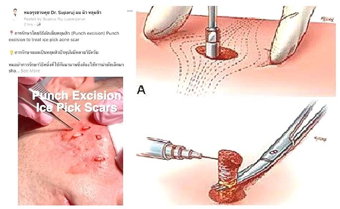ดูแลหลุมสิวด้วยเทคนิคศัลยกรรมหลุมสิว Acne Scar Revision Surgery คืออะไร ดูแลหลุมสิวด้วยเทคนิคศัลยกรรมหลุมสิว Acne Scar Revision Surgery คืออะไร