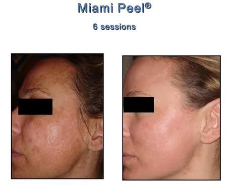 Miami Peel ® Treatment ดูแลฝ้ากระ จุดด่างดำริ้วรอย