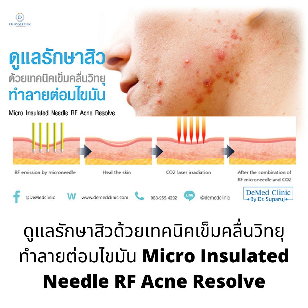 รักษาสิว สิวหิน หลุมสิวด้วยเทคนิคเข็มคลื่นวิทยุทำลายต่อมไขมัน Micro Insulated Needle RF Agness Acne Resolve รักษาสิว สิวหิน หลุมสิวด้วยเทคนิคเข็มคลื่นวิทยุทำลายต่อมไขมัน Micro Insulated Needle RF Agness Acne Resolve